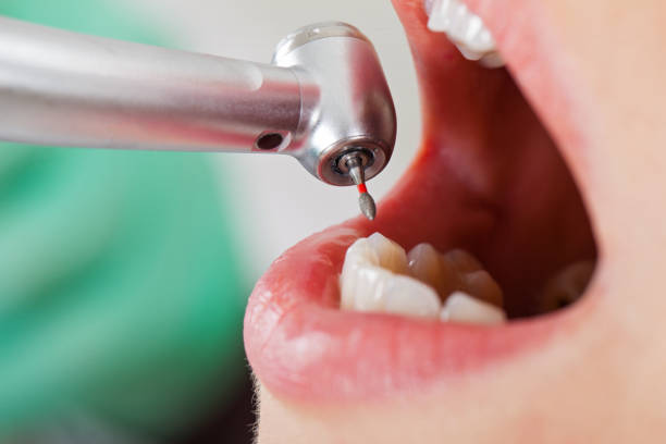 Best Emergency Dental Care for Abscessed Tooth in La Nte, MO
